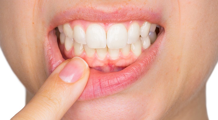 What Does It Mean If Your Gums Are White —