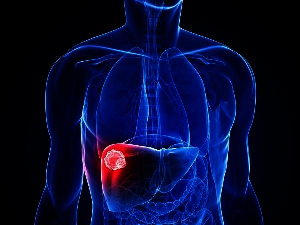 Ways of Treating Benign Liver Tumors Medically and Naturally ...